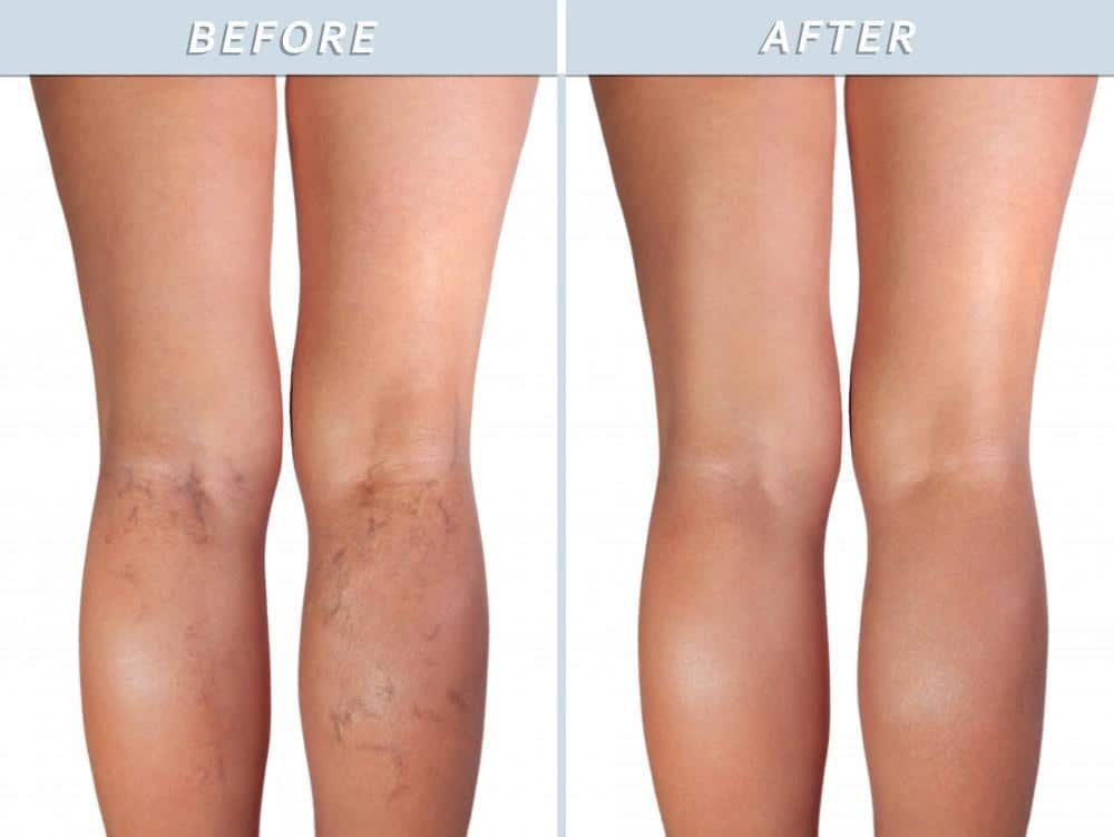 Escleroterapia 2245108