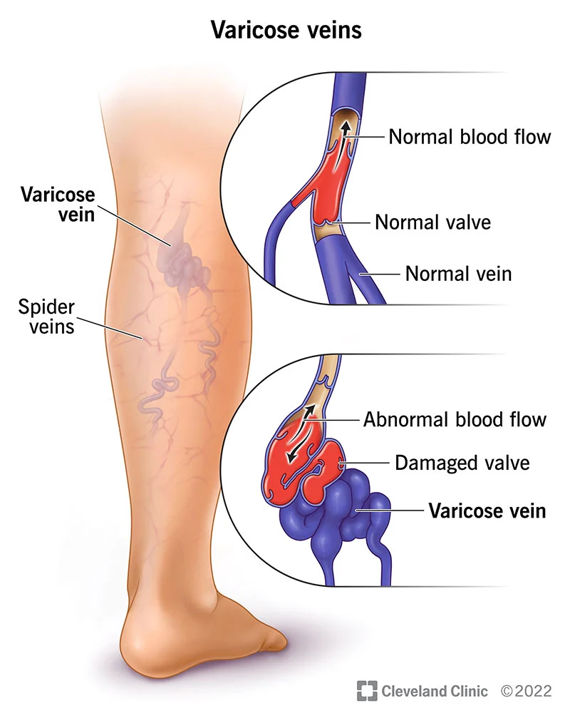 ilustración de varices