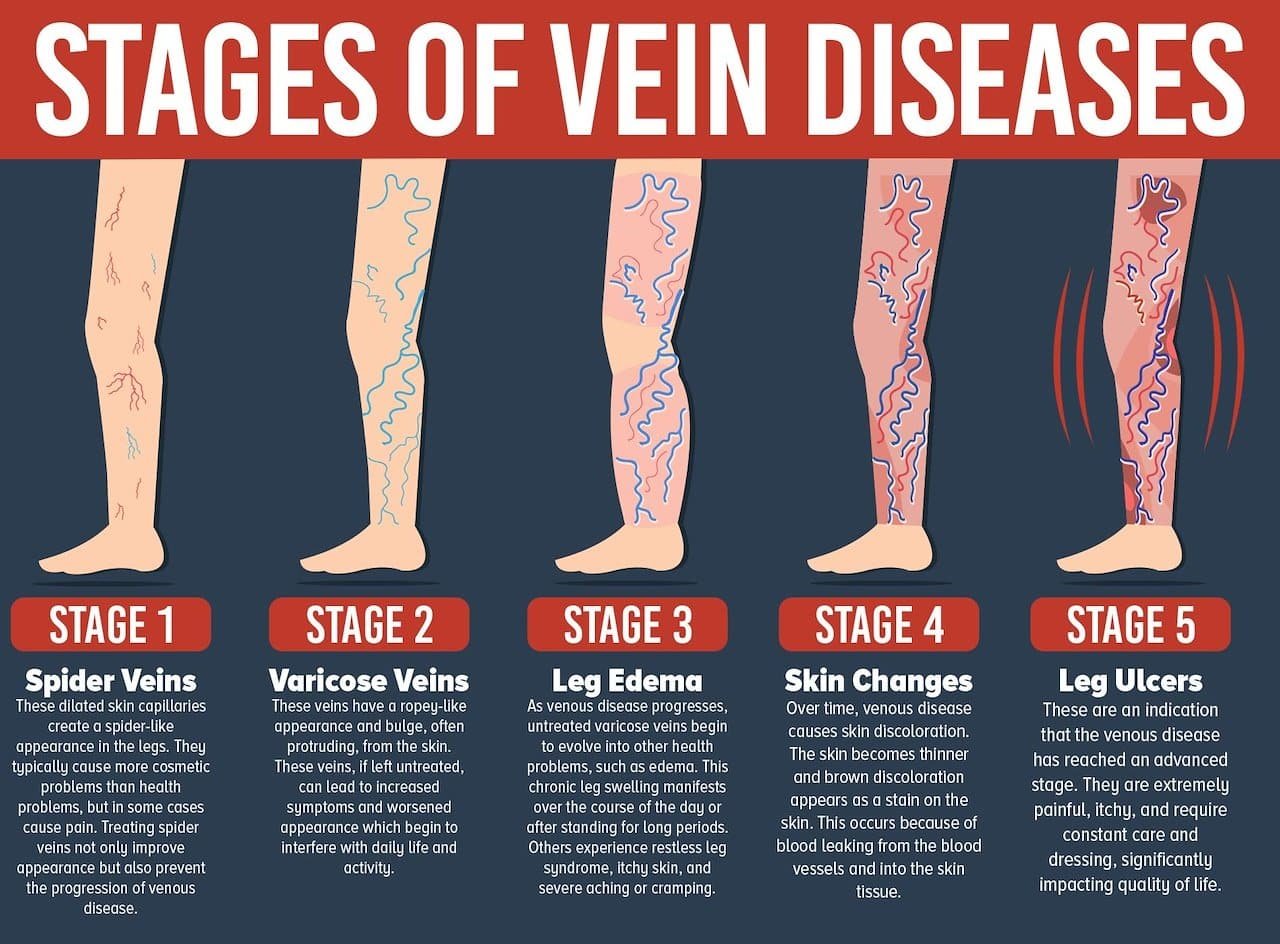 Los mejores tratamientos para las varices