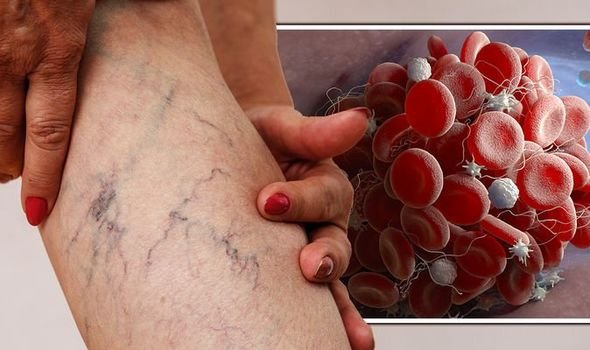 Coágulos de sangre
