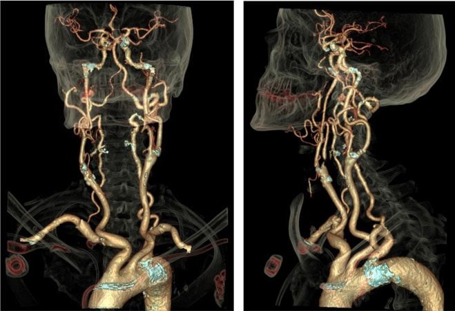 Ct-Angiography-Head-Neack