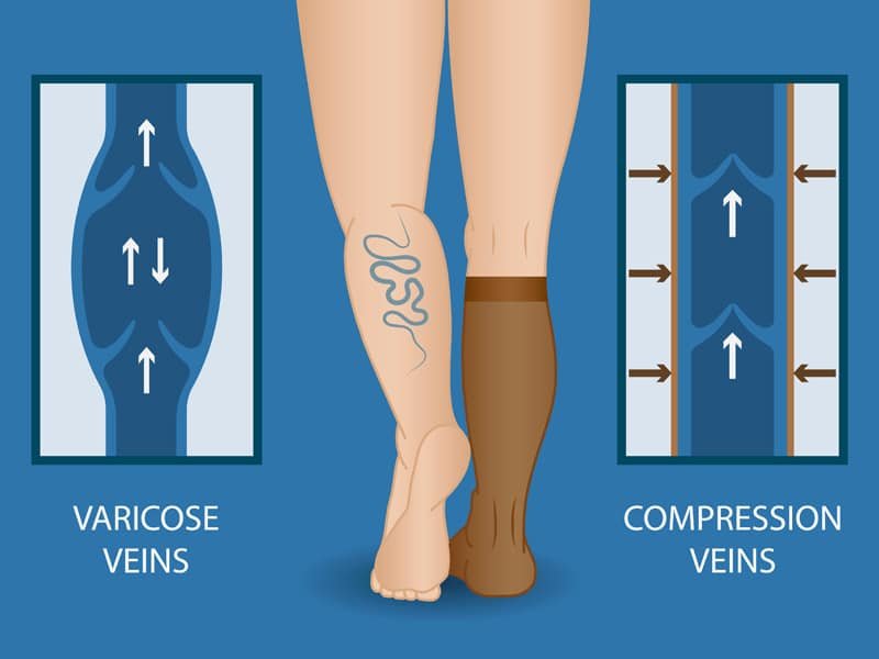 DV-compression-socks-image