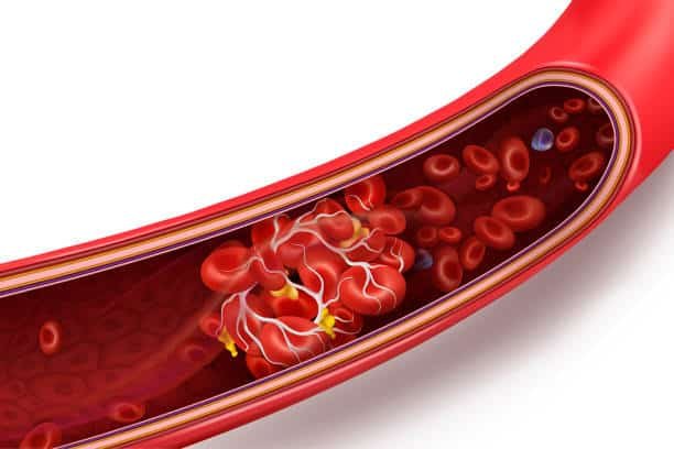 Coágulo de sangre (trombo)