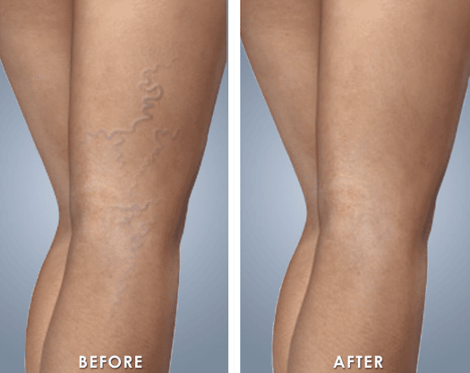 muestras de tratamiento de escleroterapia