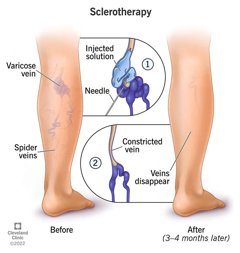 tratamiento de escleroterapia