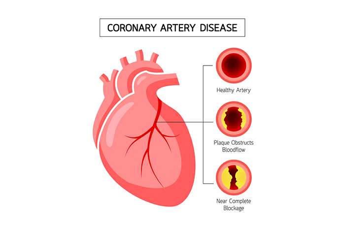 Enfermedad arterial coronaria (EAC)