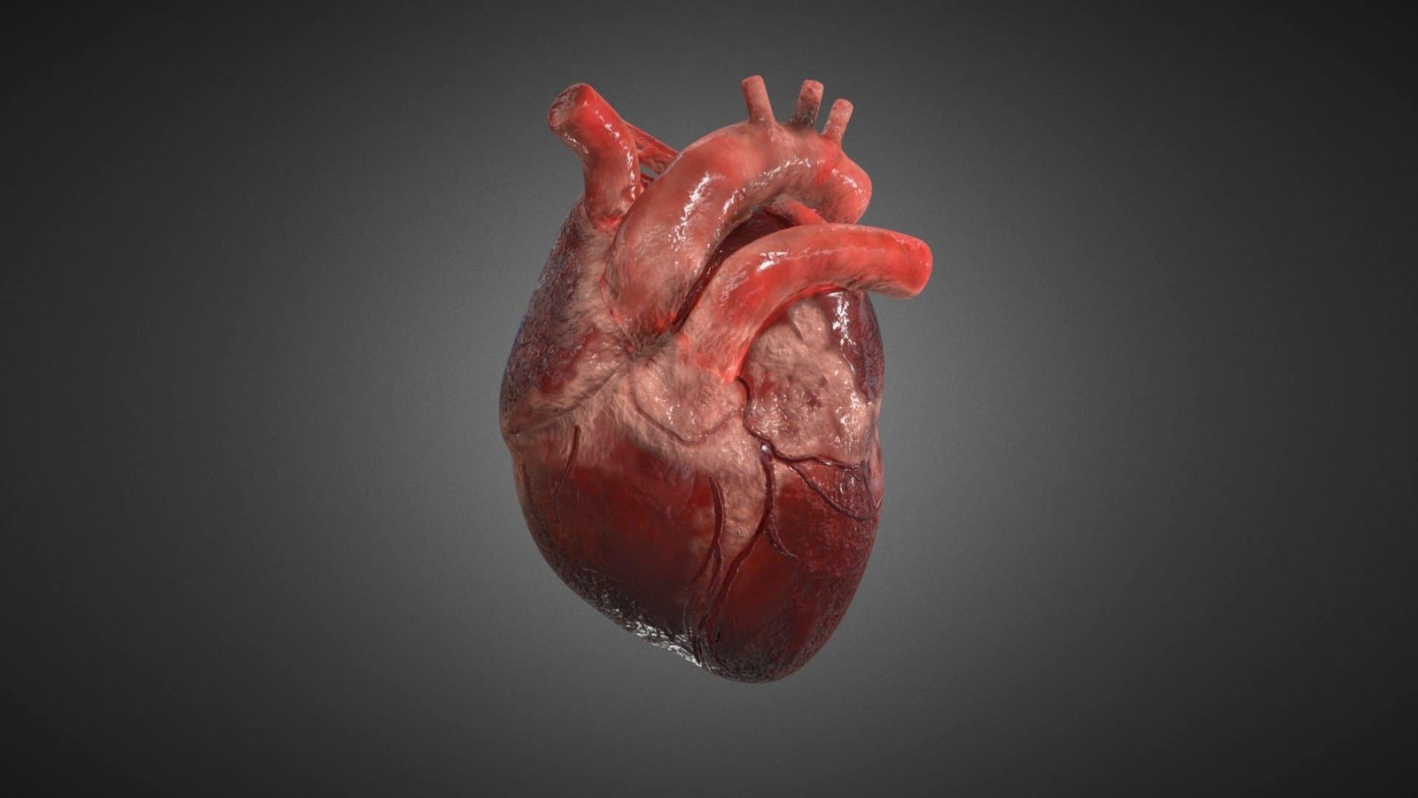 Carotid Artery Disease