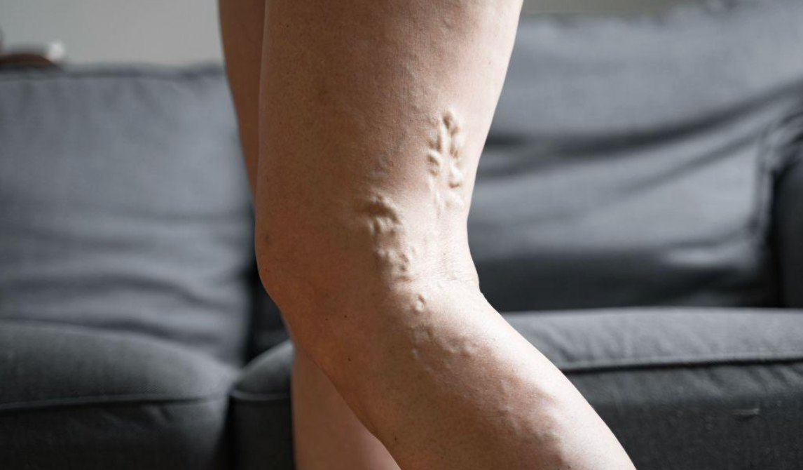 treatment options for deep vein thrombosis