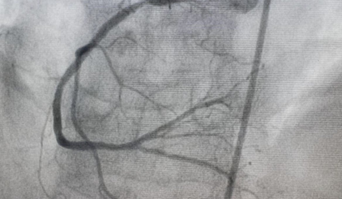 qué es una angiografía coronaria - modern heart and vascular