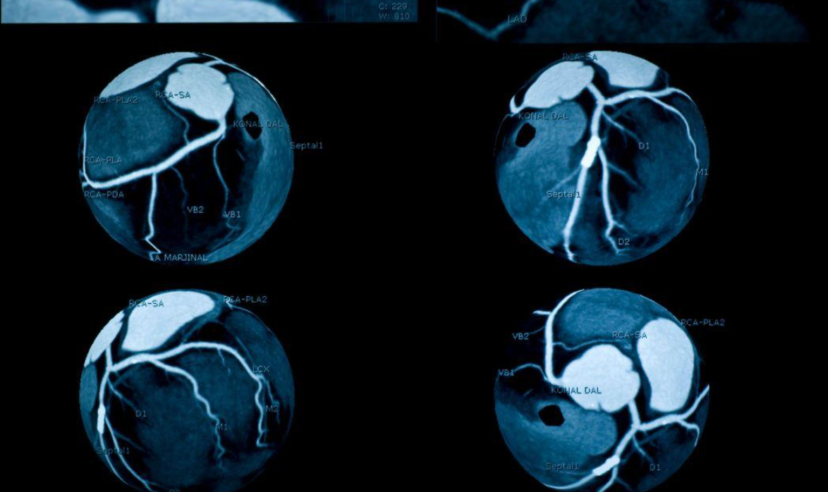 qué es el score de calcio coronario - modern heart and vascular