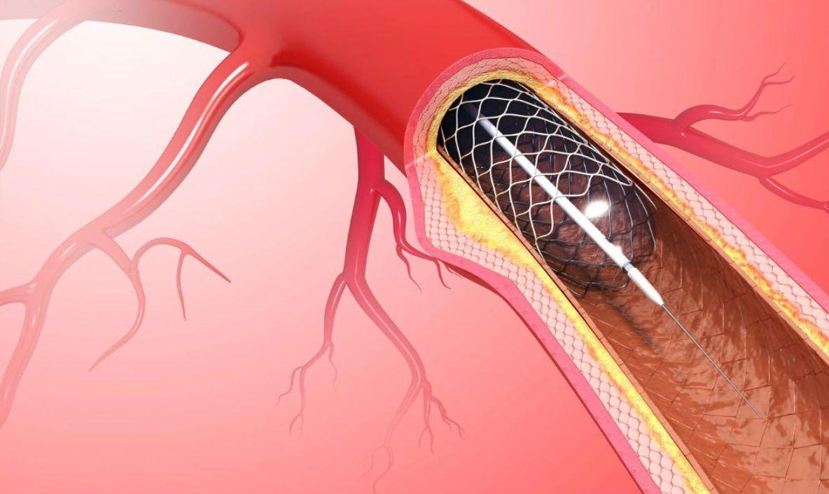 qué es la endoprótesis coronaria - modern heart and vascular